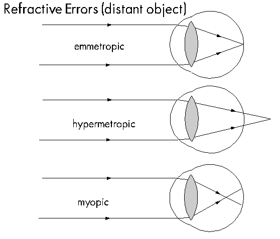 refractive errors in children, adults, kharghar, navi mumbai