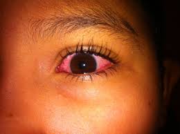 Viral Conjunctivitis