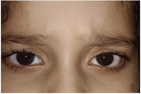 Patient after successful micro-incision squint surgery by Dr. Anand Kumar showing perfectly aligned eyes