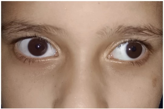 Patient before squint surgery at Utsav Eye Clinic showing eye misalignment (strabismus)
