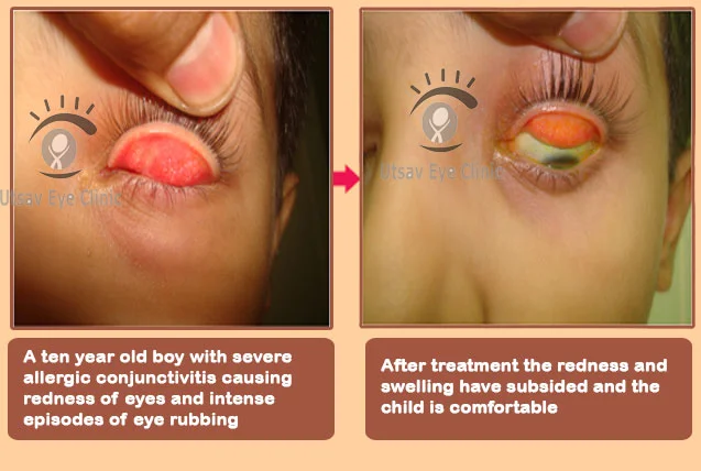 Allergic conjunctivitis in children