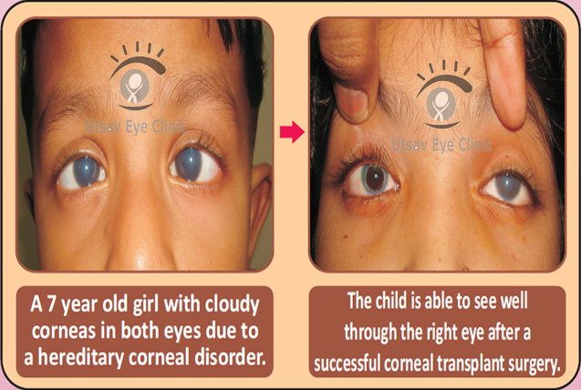 Corneal Opacity surgery