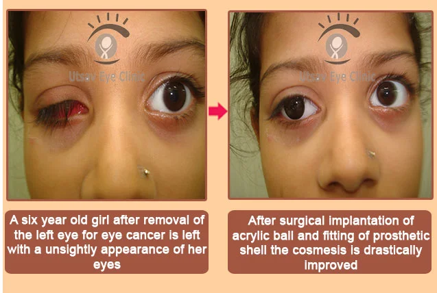 Artificial Eye surgical treatment