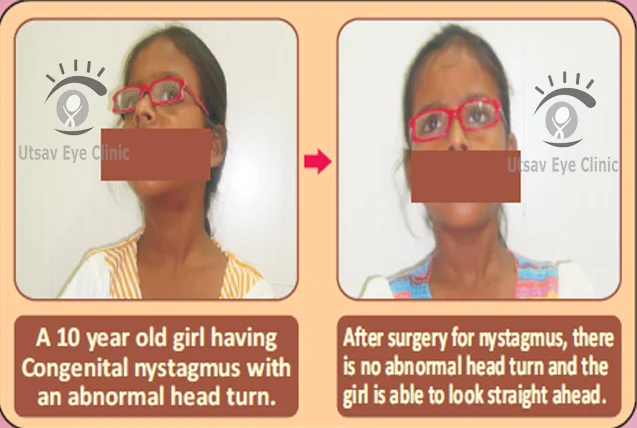 Nystagmus surgical correction