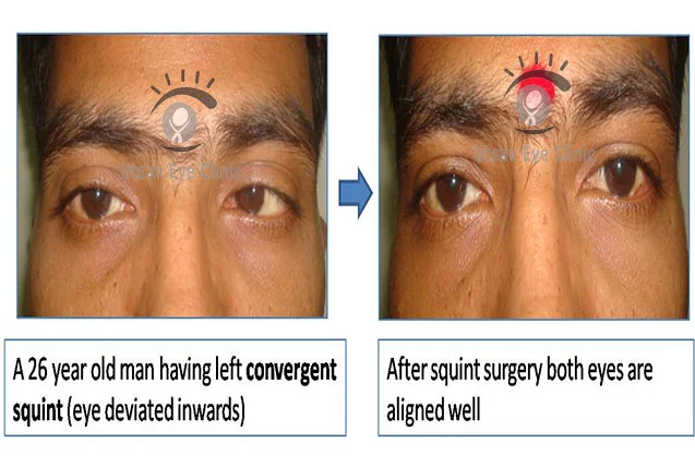 Convergent Squint surgery