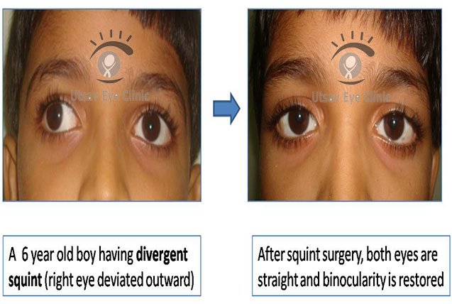 Divergent squint surgery