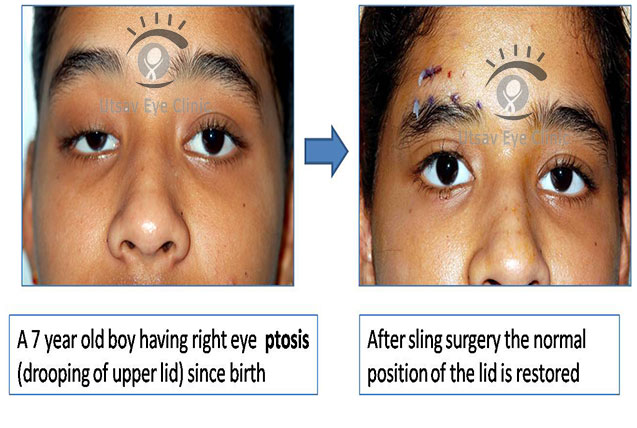 Ptosis Surgical Correction