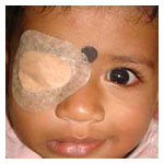 Amblyopia (lazy eyes)