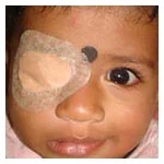 Amblyopia (lazy eyes)