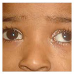 Blocked tear ducts (CNLDO)
