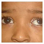 Blocked tear ducts (CNLDO)