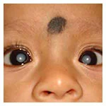 Cataract in children