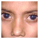 Glaucoma in children
