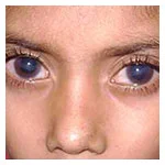 Glaucoma in children