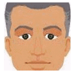 Nystagmus (Wobbling eyes)