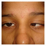 Strabismus (squint eye)