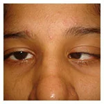 Strabismus (squint eye)