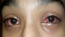 Dealing With Sore Eyes (Viral Conjunctivitis)