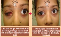 Artificial Eye – surgical treatment