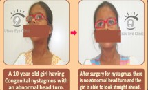 Nystagmus – surgical correction