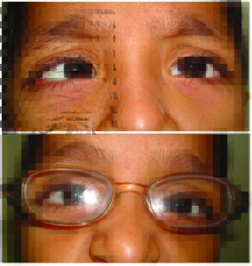 Best Squint Specialist in Mumbai India
