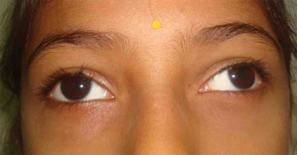 Divergent Squint Exotropia Utsav Eye Clinic